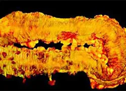 colon polyposis család, diffúz, adenomatózus