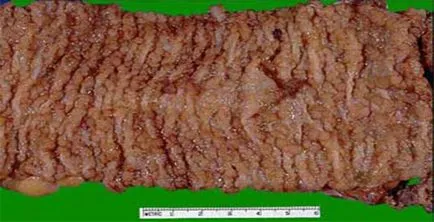 colon polyposis család, diffúz, adenomatózus