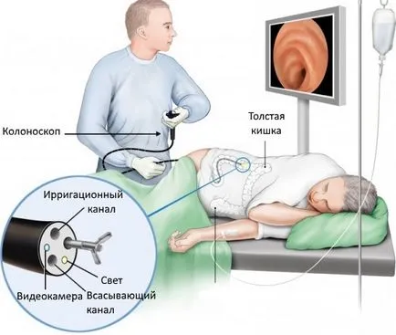 Készítmények bél tisztító előtt kolonoszkópia