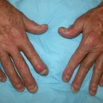 Arthritis psoriatica tünetek és a kezelés itt!