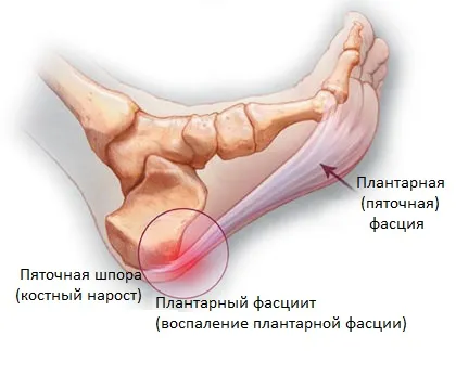 Heel шпорите - как да се отнасяме като у дома си