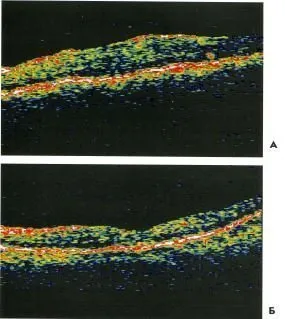 Rhegmatogen retinaleválás