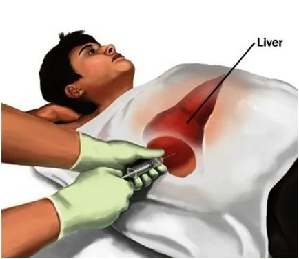 За да се направи биопсия на черния дроб в София, цената на чернодробна биопсия в Медицинския