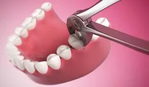 Granularea după extracția dentară, dinții noștri