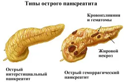 Симптомите на панкреатични заболявания при децата