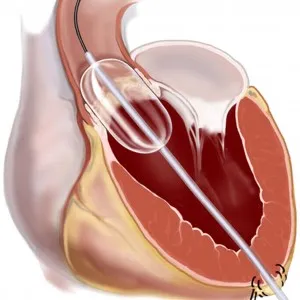 Шум на сърцето при възрастни за лечение, как за лечение на сърдечна