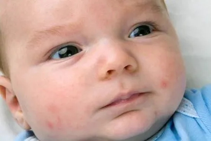 Kiütések az arcon csecsemők Komorowski - gtsf