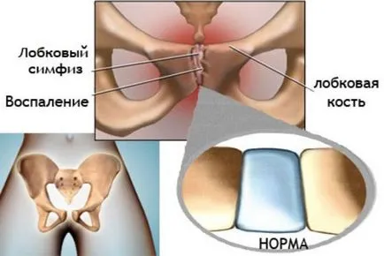 Simptome si tratament simfizita video de Sarcina