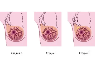 Urduroși cancer de san mucinos si coloid, si daca predictia este tratabilă