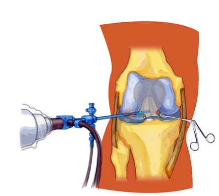 Колко е операция за отстраняване на менискуса