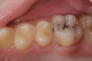 Közel fogszuvasodás megsemmisítése dentin, differenciáldiagnózis, fogászati ​​kezelés