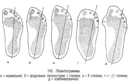 platfus statică