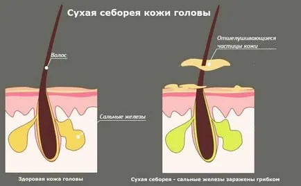 Суха себорея скалпа причини, лечение, снимки