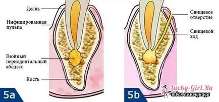 Фистула върху венците, че тя е на причините за фистула и нейните клинични прояви