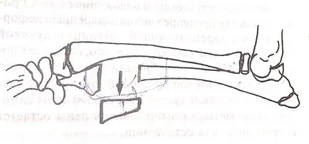 Politica de tratament chirurgical cu deformare valgus a oaselor antebrațului, articole