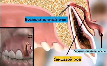 dinți fistule - ceea ce este și dacă aveți nevoie pentru a elimina un dinte