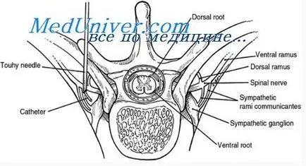 tehnica blocadă paravertebral