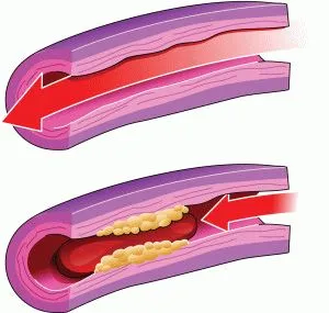 Thrombophlebitis felületes vénák az alsó végtagok szakaszban, a tünetek, a kezelés