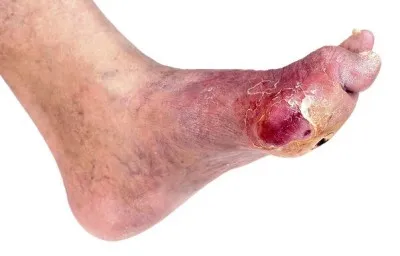 Thrombophlebitis tünetek és jelek