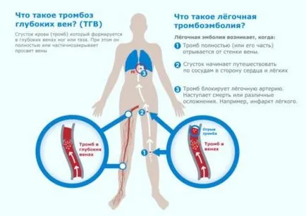 Thrombophlebitis jellegzetes tünetek és kezelési eljárások, uflebologa