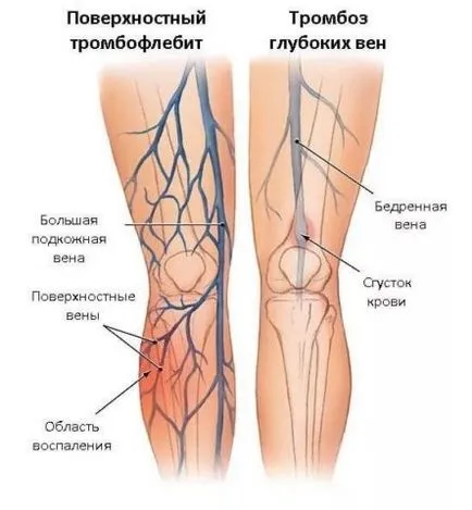 Thrombophlebitis jellegzetes tünetek és kezelési eljárások, uflebologa