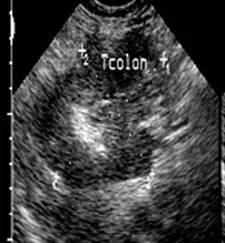 Diagnostic cu ultrasunete de obstrucție intestinală