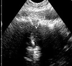 Diagnostic cu ultrasunete de obstrucție intestinală