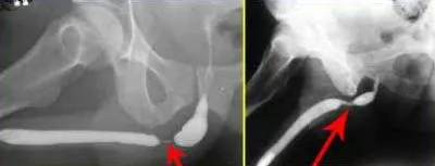 bărbați urethrography (în creștere și anularea)