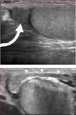 Uzi hidrocel testicular cu urolog meu