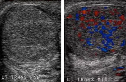 Узи тестисите хидроцеле с уролога