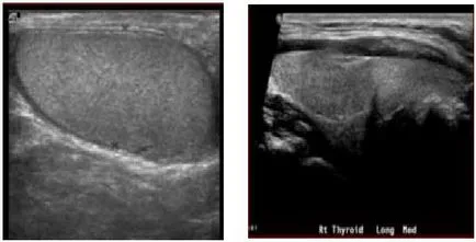 Узи тестисите хидроцеле с уролога