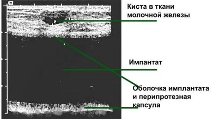 Узи на гърдата с импланти