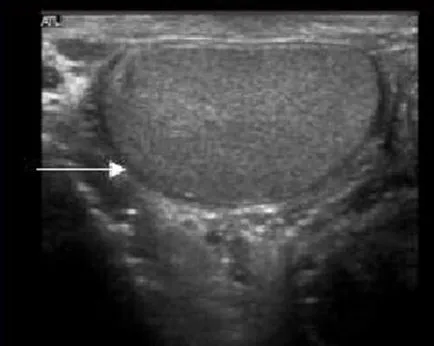 Uzi hidrocel testicular cu urolog meu