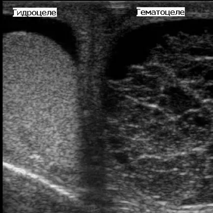 Uzi hidrocel testicular cu urolog meu