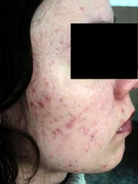 acne vulgaris