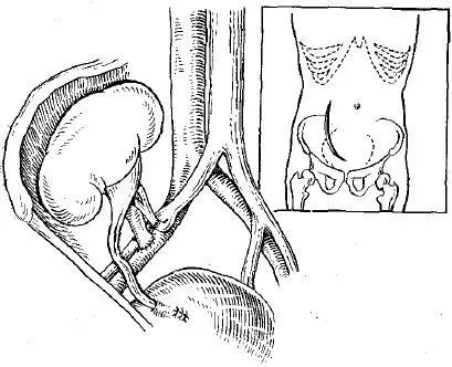 Tehnica chirurgicala de transplant renal