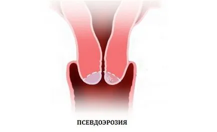 Характерни особености на рак на маточната шийка симптоми ерозия и лечение