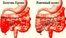 A colitis ulcerosa - a kilátások a külföldi gyógykezelés