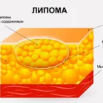 Wen (lipoma) a test fotó okoz, hogyan lehet megszabadulni