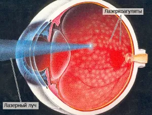 A retinopathia a gyermek szeme, a szem kezelésére otthon