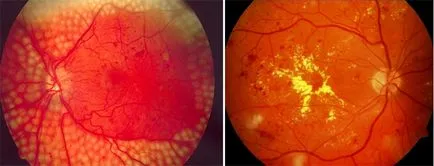 Ретинопатия причини за очни симптоми и патологии, как за лечение на болестта на