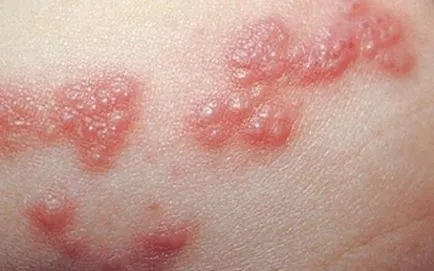 Алергия към папата в едно дете - червено, бяло, силно и малък обрив, причинява, лечение