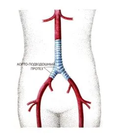 Ateroscleroza de aorta si arterele membrelor inferioare (examinare și tratament)