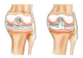 Osteoarthritis a térd tünetek, okok és a kezelés