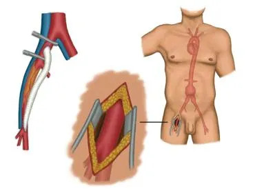 Ateroscleroza de aorta si arterele membrelor inferioare (examinare și tratament)