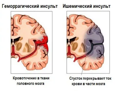 Право удар ръка, особено в напреднала възраст, както и това, което е по-опасно от десностранна или