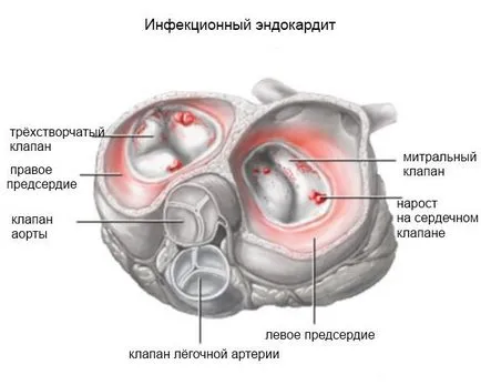 Infectios endocardita la copii - cauze, simptome, tratament