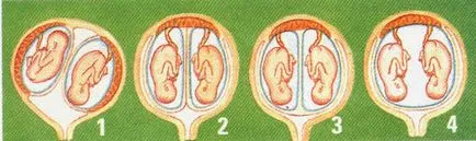 Sarcina în cazul în care sunt luate gemenii