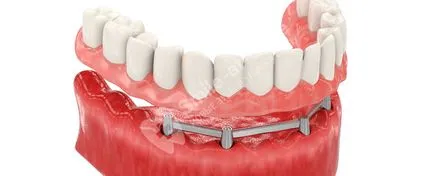 Beam fogsor implantátum támaszkodva előnyeit, ár, vélemények