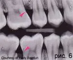 Gyorsan előrehaladó (agresszív) periodontiíissei marginális koncepció gyorsan halad